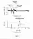 Fig. 07 - Methods and apparatus for controlling neurostimulation using evoked physiologic events