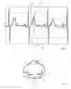 Fig. 04 - Method and device for recording an electrocardiogram