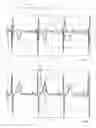 Fig. 05 - Method and device for recording an electrocardiogram