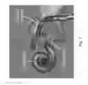 Fig. 08 - Apparatus and methods for percutaneous cochlear implantation