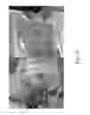Fig. 13 - Apparatus and methods for percutaneous cochlear implantation