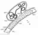 Fig. 01 - Sacrificial anode stent system
