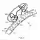 Fig. 02 - Sacrificial anode stent system