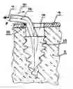 Fig. 01 - SUTURE BONE ANCHOR
