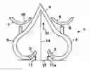Fig. 01 - Simple portable lumbar spine distraction device and method