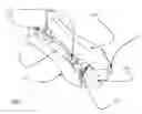 Fig. 01 - Interarticulating spinous and transverse process staples for spinal fusion