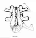 Fig. 09 - Interarticulating spinous and transverse process staples for spinal fusion