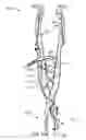 Fig. 35 - Spinous process fusion implants and insertion, compression, and locking instrumentation