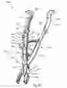 Fig. 45 - Spinous process fusion implants and insertion, compression, and locking instrumentation