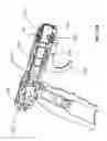 Fig. 35 - Bone implantation and stabilization assembly including deployment device