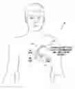 Fig. 01 - Systems and methods for use by an implantable medical device for controlling multi-site CRT pacing in the presence of atrial tachycardia