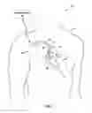 Fig. 02 - Terminating tachyarrhythmias