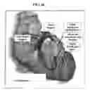 Fig. 43 - Systems, devices and methods relating to endocardial pacing for resynchronization