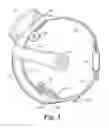 Fig. 04 - Retinal prosthesis with side mounted inductive coil