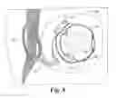 Fig. 07 - Retinal prosthesis with side mounted inductive coil