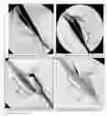 Fig. 16 - DEVICE AND METHOD FOR PREVENTING STENOSIS AT AN ANASTOMOSIS SITE