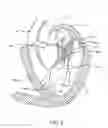 Fig. 03 - Transcatheter mitral valve prosthesis