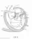 Fig. 04 - Transcatheter mitral valve prosthesis