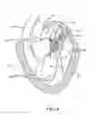 Fig. 06 - Transcatheter mitral valve prosthesis