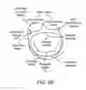 Fig. 08 - Transcatheter mitral valve prosthesis