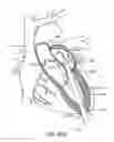 Fig. 30 - Transcatheter mitral valve prosthesis