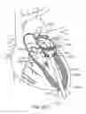 Fig. 33 - Transcatheter mitral valve prosthesis