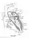 Fig. 34 - Transcatheter mitral valve prosthesis