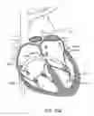 Fig. 37 - Transcatheter mitral valve prosthesis