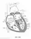 Fig. 40 - Transcatheter mitral valve prosthesis