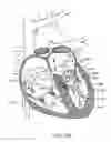 Fig. 41 - Transcatheter mitral valve prosthesis