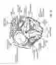 Fig. 44 - Transcatheter mitral valve prosthesis