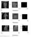 Fig. 03 - STENT LOCALIZATION IN 3D CARDIAC IMAGES