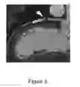 Fig. 04 - STENT LOCALIZATION IN 3D CARDIAC IMAGES