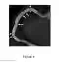 Fig. 05 - STENT LOCALIZATION IN 3D CARDIAC IMAGES
