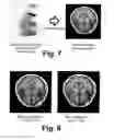 Fig. 08 - MAGNETIC RESONANCE PARTIALLY PARALLEL IMAGING (PPI) WITH MOTION CORRECTED COIL SENSITIVITIES