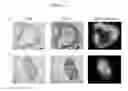 Fig. 11 - METHOD FOR EARLY IMAGING OF ATHEROSCLEROSIS
