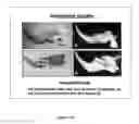 Fig. 15 - Bone-like prosthetic implants