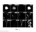 Fig. 02 - Lateral ventricle cell compositions and use for treating neural degenerative diseases