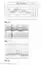 Fig. 12 - Unit doses, aerosols, kits, and methods for treating heart conditions by pulmonary administration