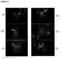 Fig. 14 - METHOD OF REDUCING MULTI-DRUG RESISTANCE USING INOSITOL TRIPYROPHOSPHATE