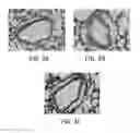 Fig. 03 - Use of A2B Adenosine Receptor Antagonists for Treating Pulmonary Hypertension