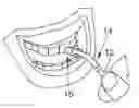 Fig. 01 - ENDODONTIC DIAGNOSTIC INSTRUMENT
