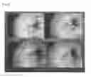 Fig. 03 - Method for treating skin aging by administration of bFGF