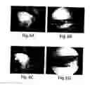 Fig. 06 - Method for treating ocular demodex