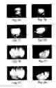 Fig. 07 - Method for treating ocular demodex