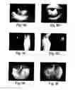Fig. 09 - Method for treating ocular demodex