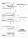 Fig. 24 - Rotate-to-advance catheterization system