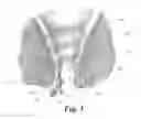Fig. 06 - System and method for treating hemorrhoids