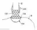 Fig. 01 - SATIATION POUCHES AND METHODS OF USE