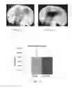 Fig. 11 - Methods of treating degenerative bone conditions